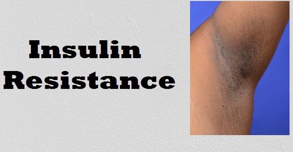Insulin Resisitance skin manifestation: acanthosis nigricans